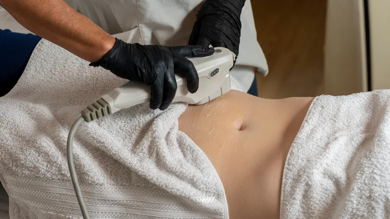 HIFU high-intensity focused ultrasound body sculpting treatment