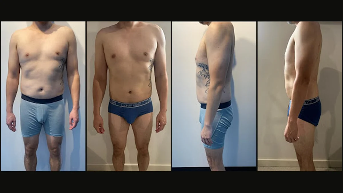 Before and after body sculpting results after rapid weight loss