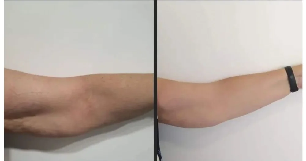 Arm toning before and after results