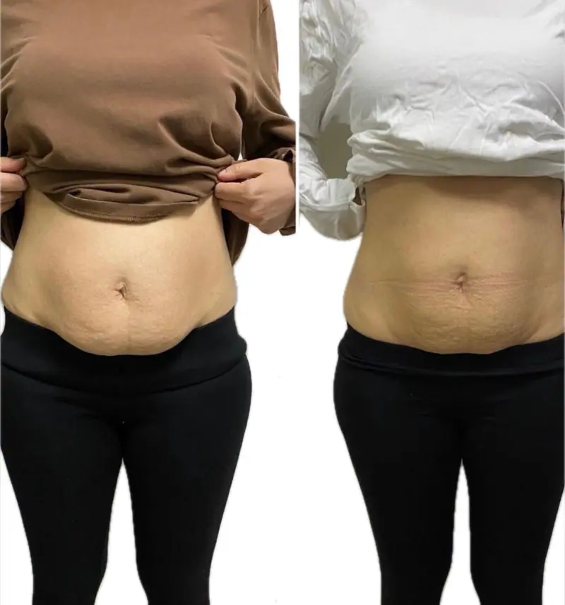 Belly fat reduction