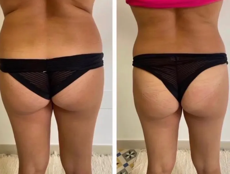 Glutes sculpting results