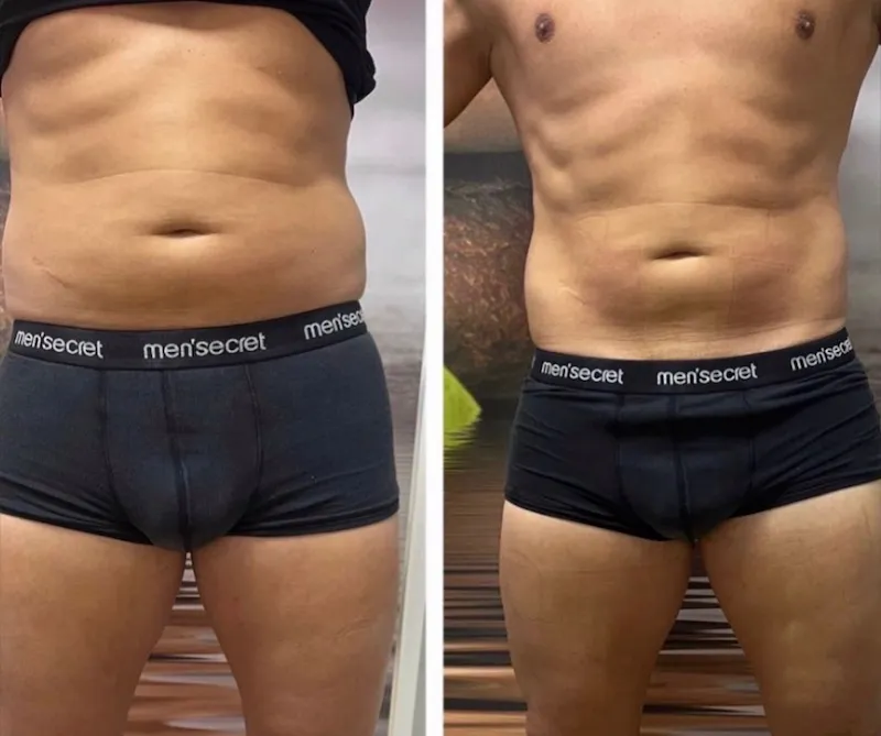 Love handles reduction